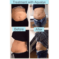 Aqualyx Fat Dissolving (1 box)