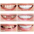 1 Pair Dentistry Cosmetic Covers Smile Comfort Veneers Flex Teeth Braces Upper +Bottom