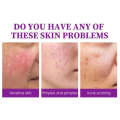 Beauty Anti Acne Fade Acne Marks Handmade Body and Face Soap-120g 4:1/ 4pc
