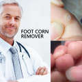 5pcs/pack Foot Corn Remover Feet Care