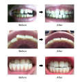 Teeth Aligner - Complete Stage 1, 2 & 3 Set - Adult - invisible