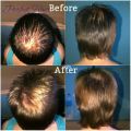 Grow Thick, Long, Beautiful Hair - Platinum Hair Growth Treatment - Stop Hair Loss