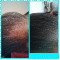 Restore Hairline, Grow Hair - NuLengths African Hair Growth Treatment - Stop Hair Loss Now!