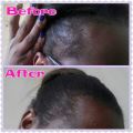 Restore Hairline, Grow Hair - NuLengths African Hair Growth Treatment - Stop Hair Loss Now!