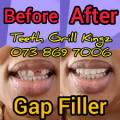 Teeth Repair Filling Temporary FILLERS - Large Pack