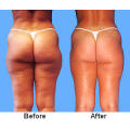 Lose 25 cm's of total body FAT per hour !! 5 week program, SA's No 1 Javanti Wrap program!