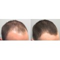 TrichoMed Minoxidil Spray 5% For Hair Loss - 60ml (6 Month Supply)