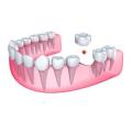 FIX-YOUR-SMILE - D.I.Y. temp replacement tooth 10g