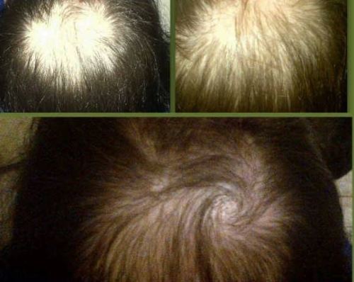 Peanie Natural Hair Tonic, Hair Growth, Hair Products, Hair Evolution, 3cm in 3 days, alopecia, scalp