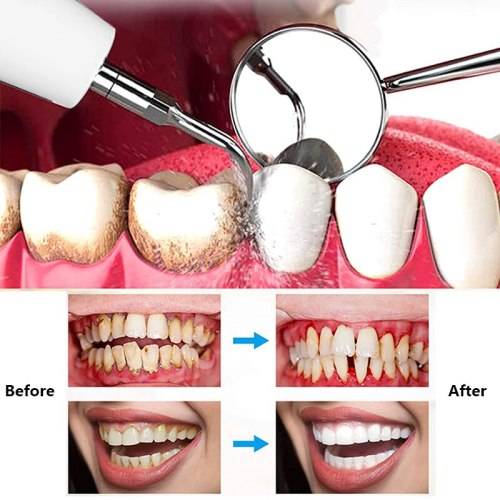 Other Oral Care - Electric Portable Ultrasonic Teeth Dental Scaler With ...