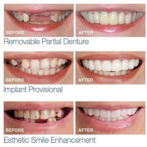 Orthodontic Supplies Full Set Teeth Veneers was sold for R75.00 on 5