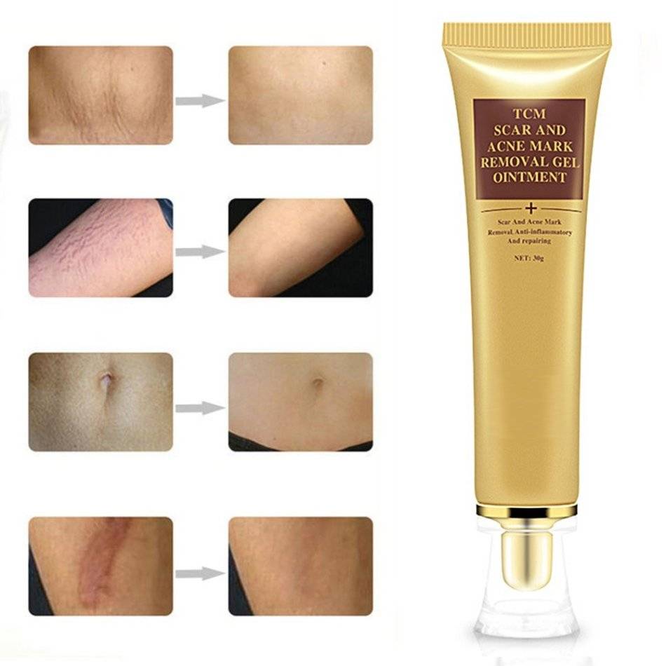 Лазерная коррекция растяжек на животе. Mark removal. Mark removal. Серум от шрамов и растяжек lanbena scar removal stretch marks serum, 20 мл. Крем lanbena.